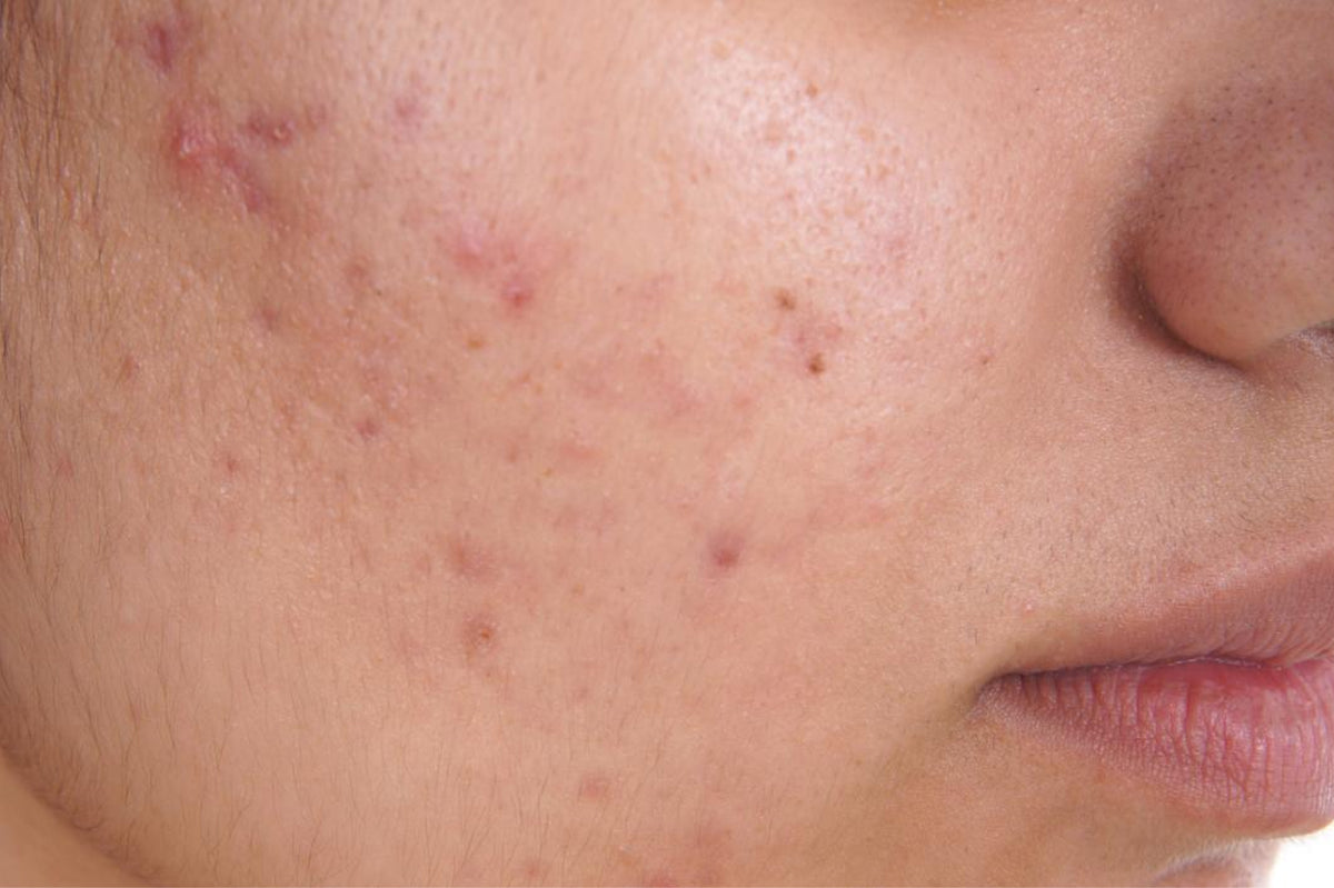 Purging or Breaking Out? Here's how you can tell!