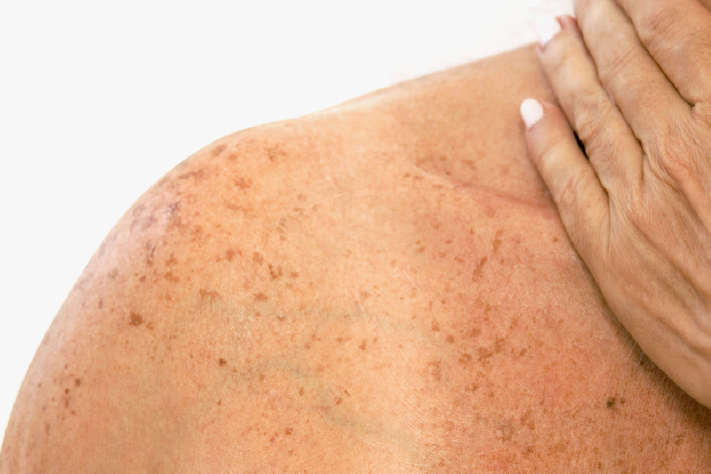 signs of sun damaged skin