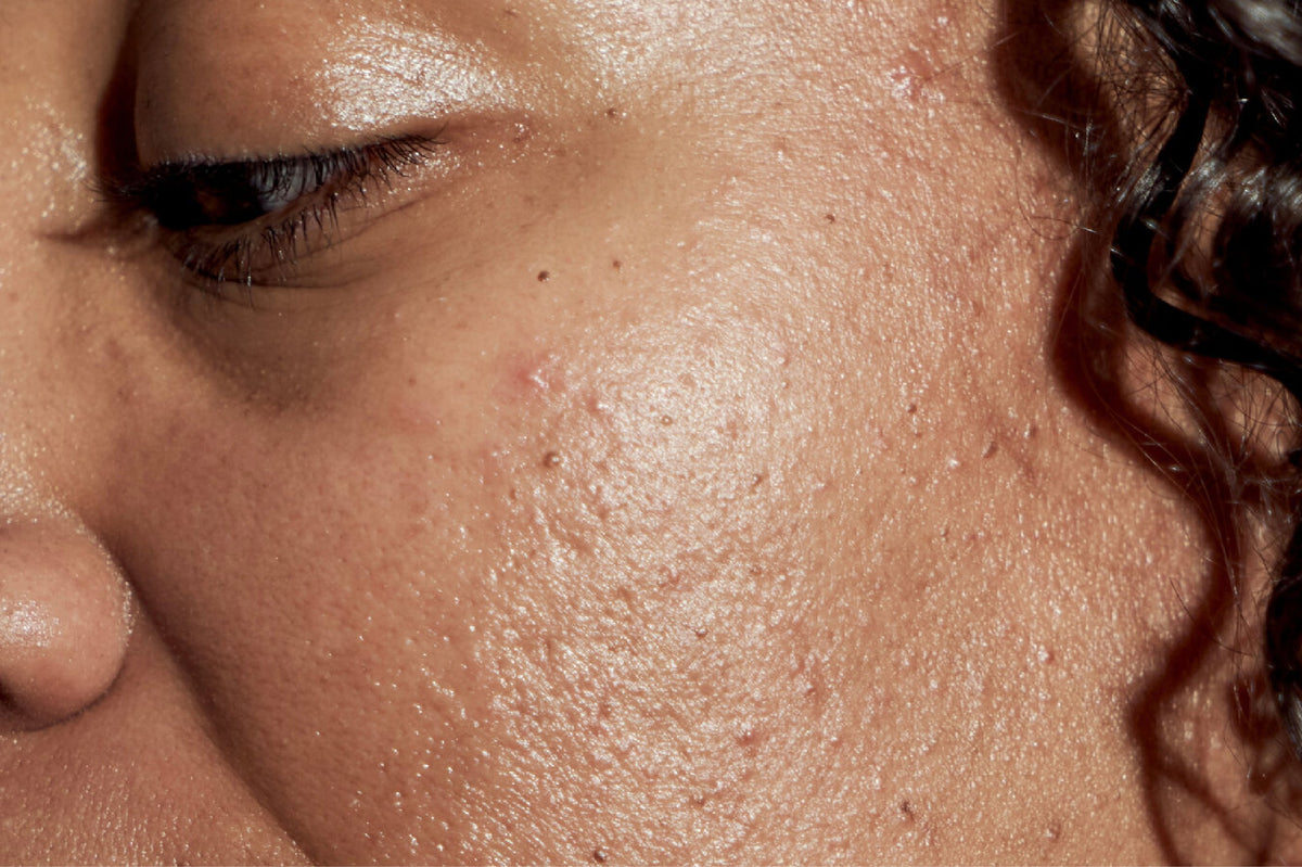 Acne: Types, Causes, Treatment, and Prevention