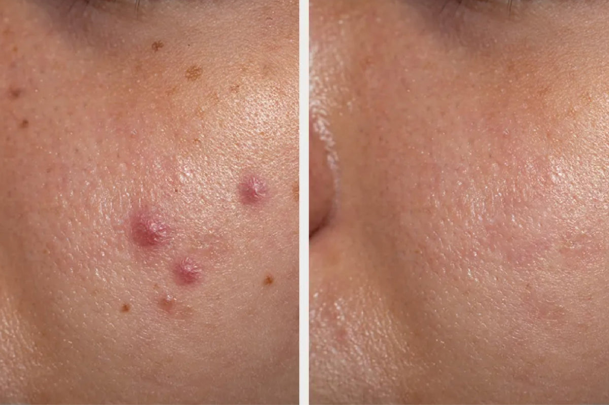 Acne vs. Acne Scars: How Niacinamide Tackles Both