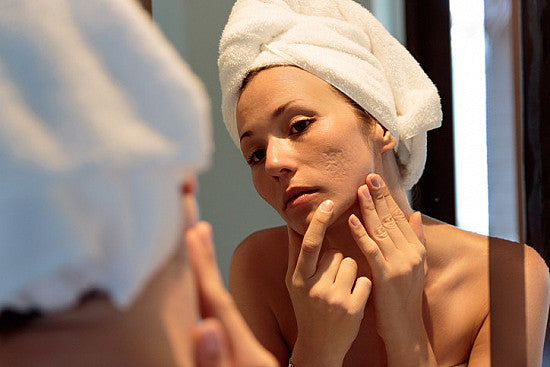 Know the Causes And Treatments of sudden Acne Breakouts