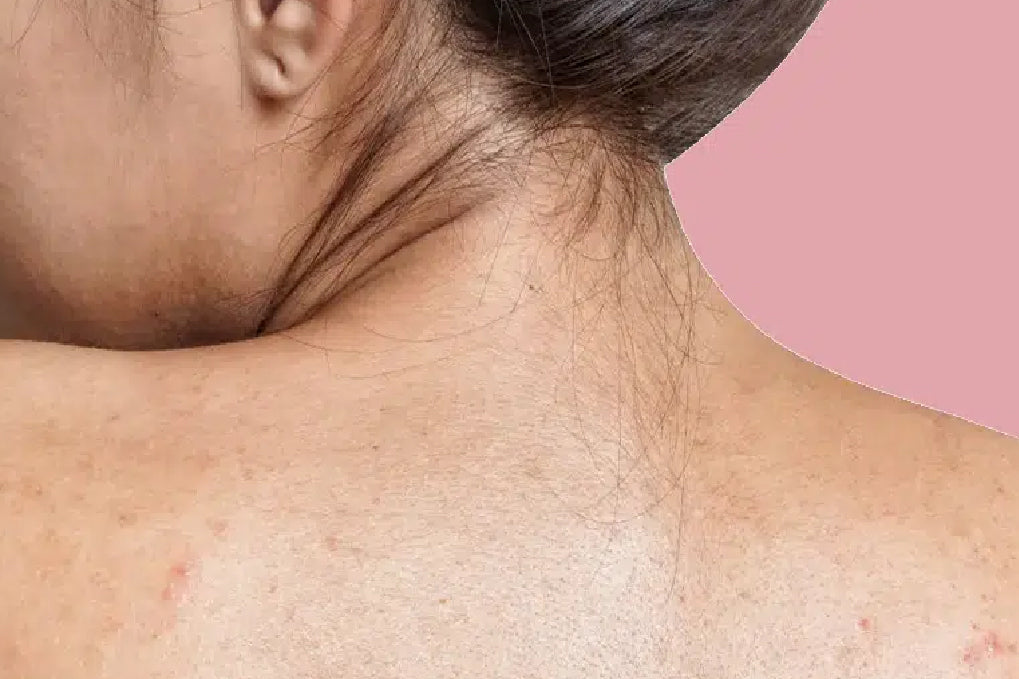 Back Acne “Bacne” Breakout? How to Treat & Prevent Back Pimples