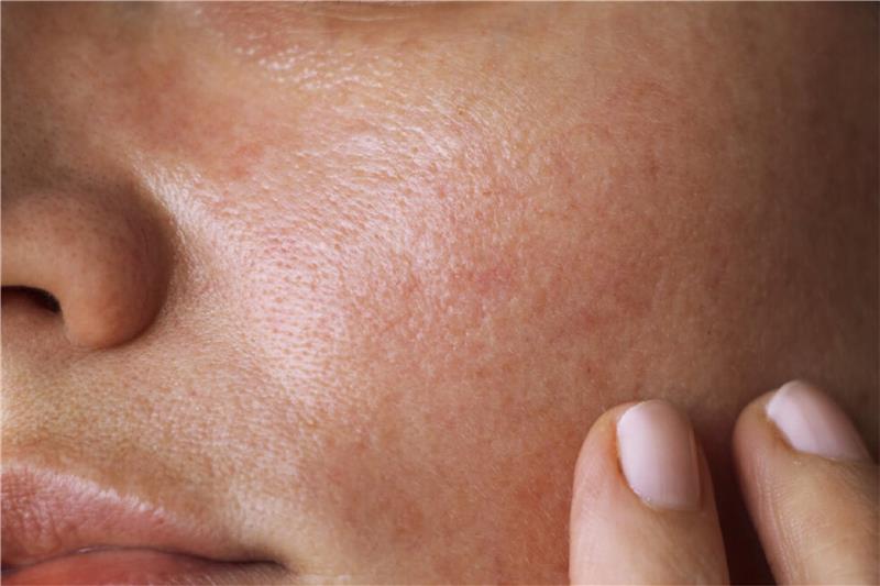 Can oily skin be dehydrated?