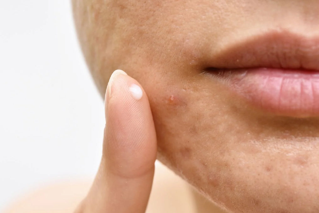 can sunscreen cause breakouts?