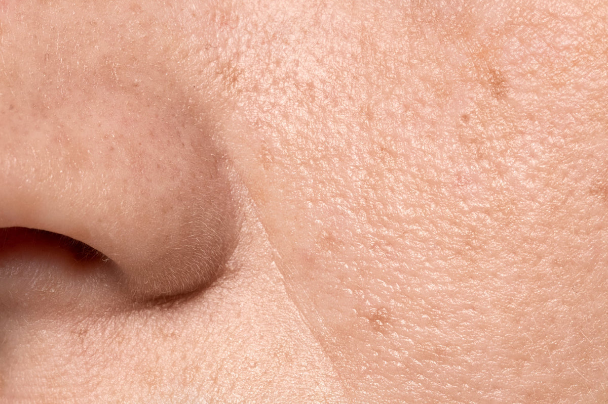 Difference between whiteheads & blackheads