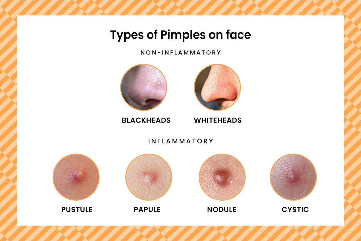 Types Of Acne & Pimples