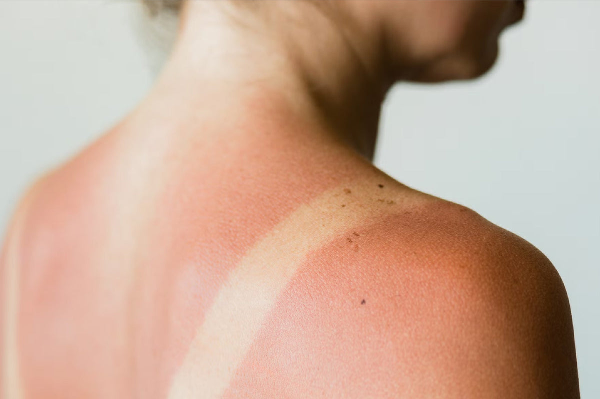 dos and don'ts after sun exposure
