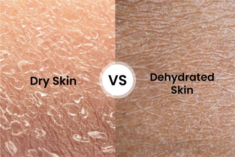 Dry Skin vs Dehydrated Skin