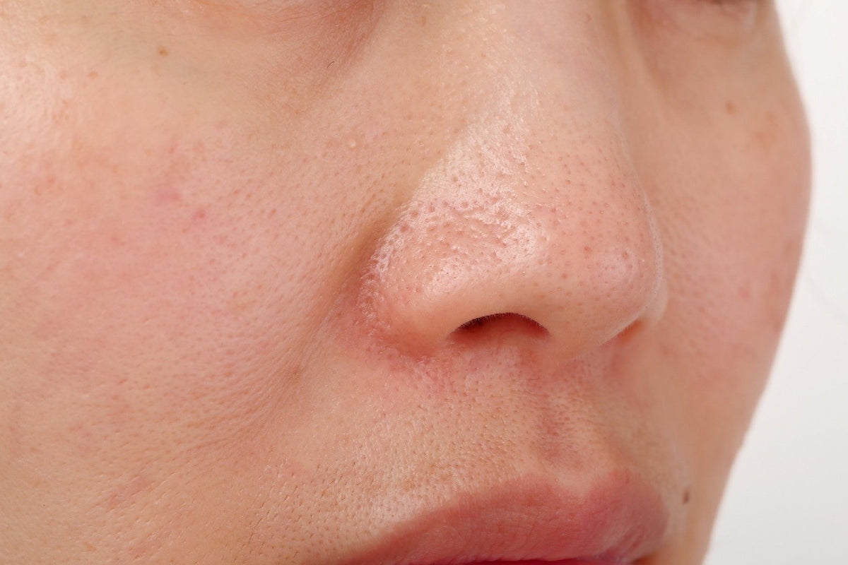 Effective Treatments for Open Pores