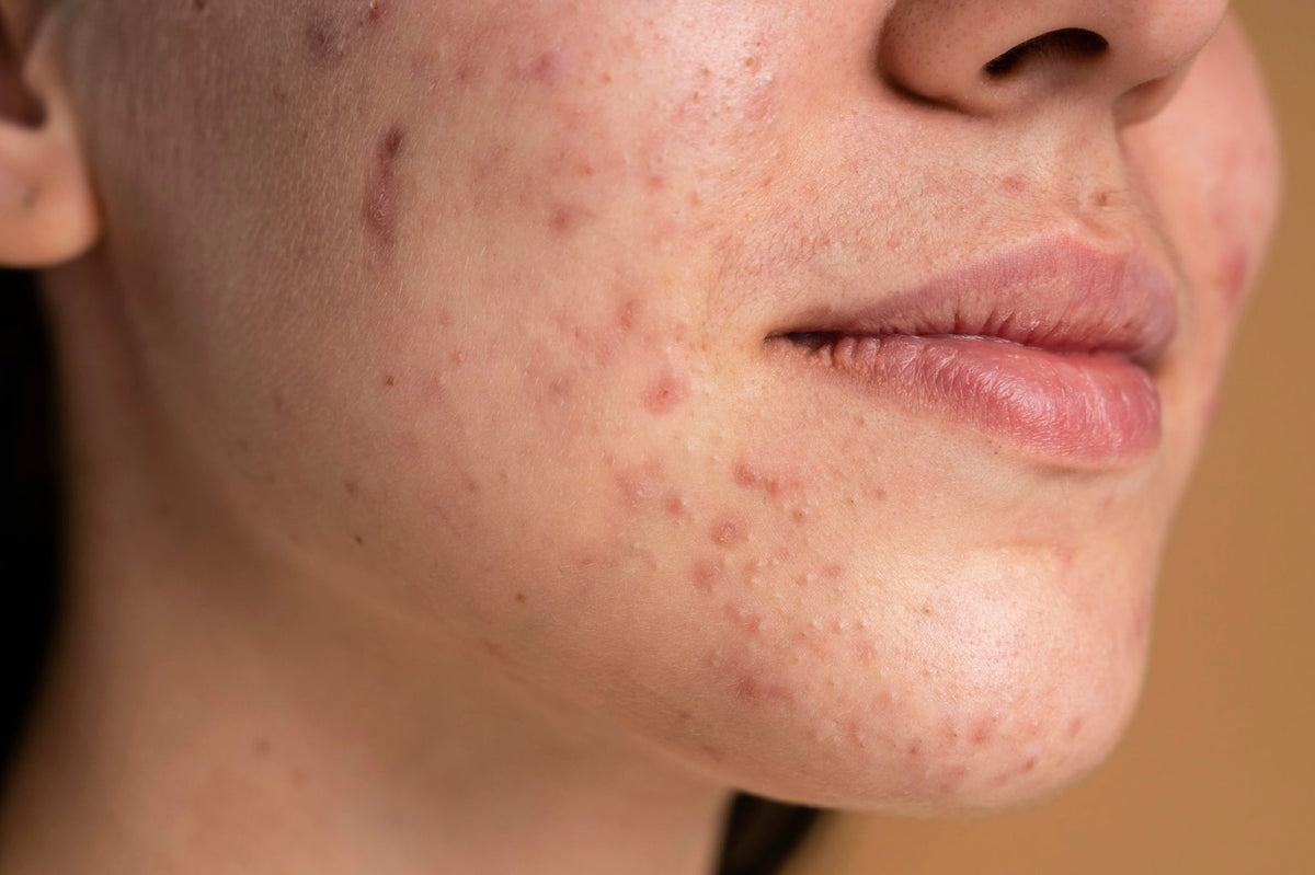 How Azelaic Acid and Niacinamide Together Can Fight Both Redness and Dark Spots
