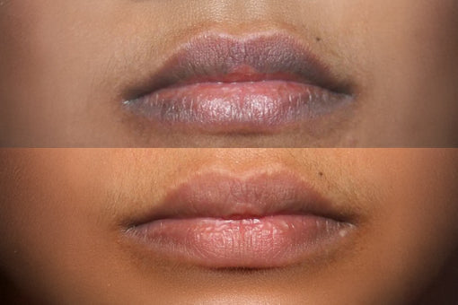 reducing darkness around lips