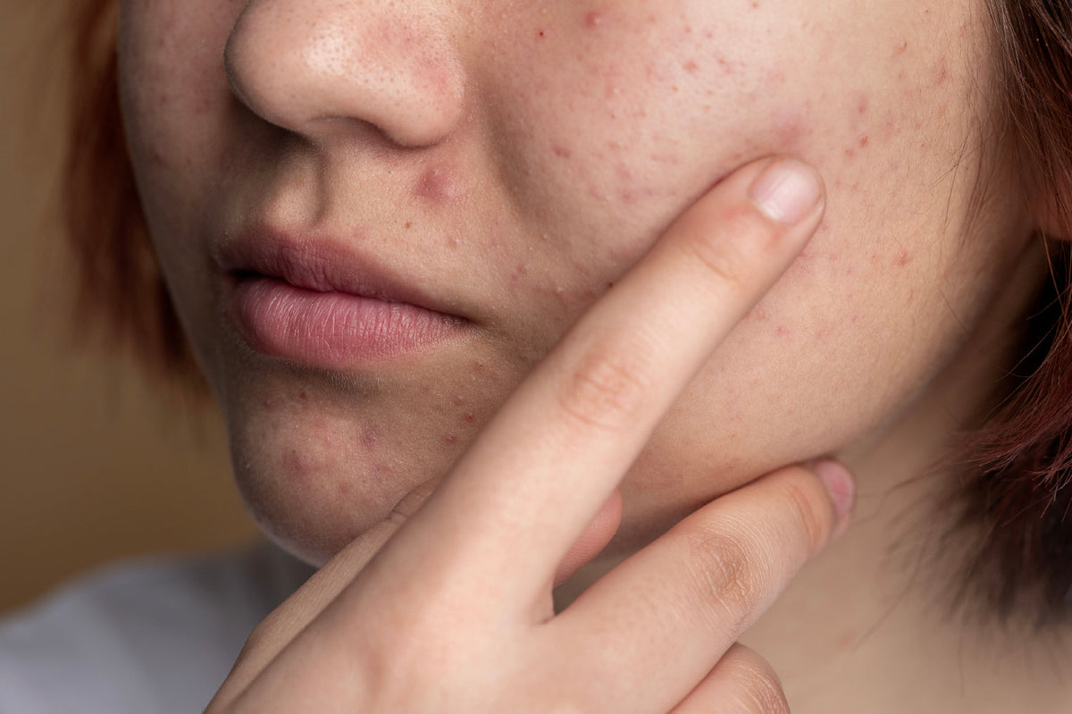 How to Transition to An Acne Control Cleanser Without Irritating Your Skin