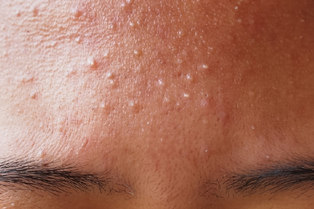 sweat induced breakouts