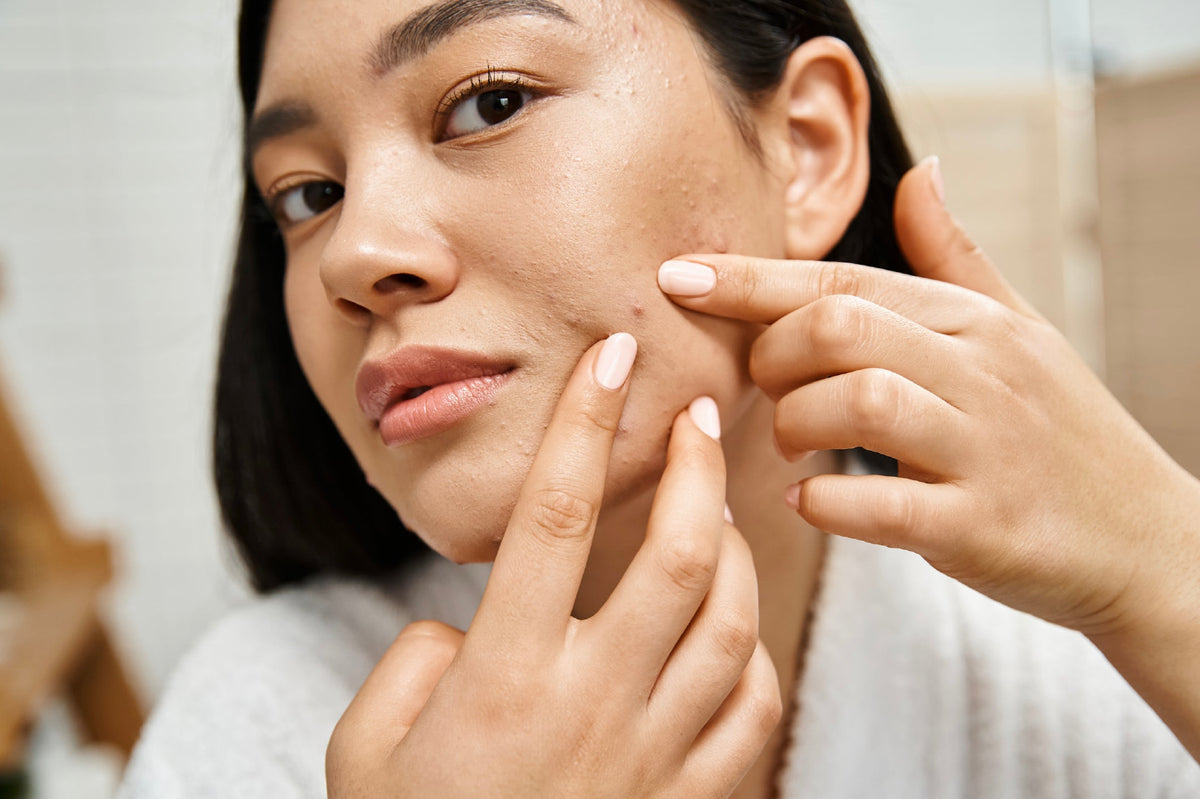Controlling oil and acne in monsoon