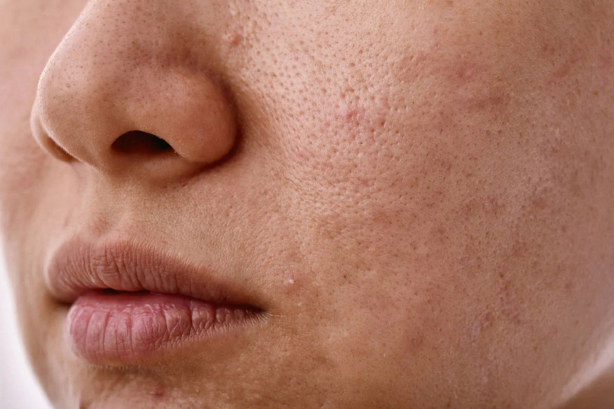 Niacinamide for sebum regulation
