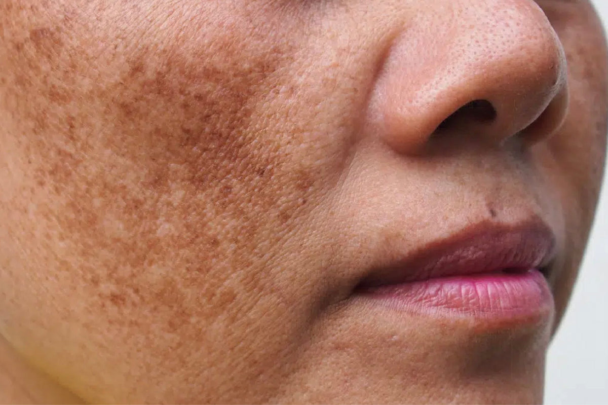 What is Post Inflammatory Hyperpigmentation: Causes, Prevention & Treatments
