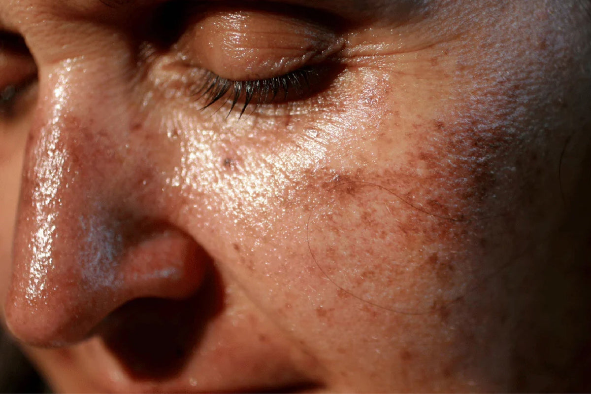 Reverse Sun Damage: 5 Expert-Suggested Ways to Restore Your Skin