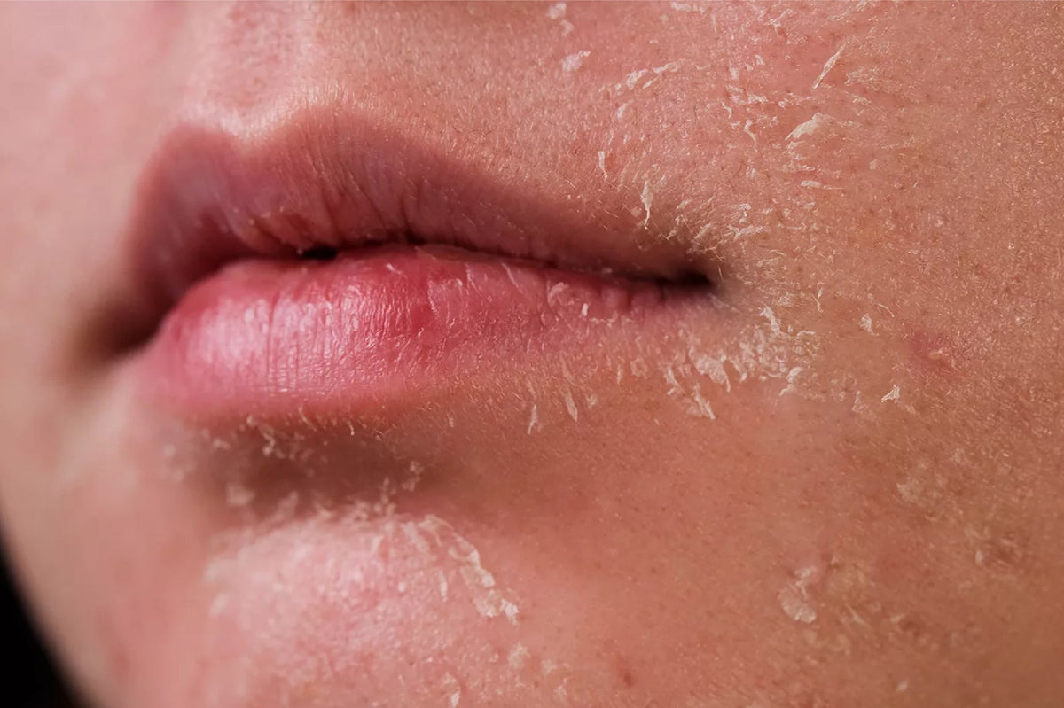 Niacinamide for dry skin