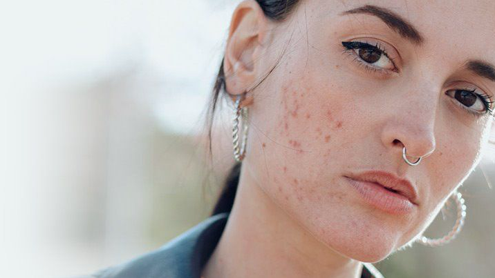 How to keep your skin acne-free during the period cycle?