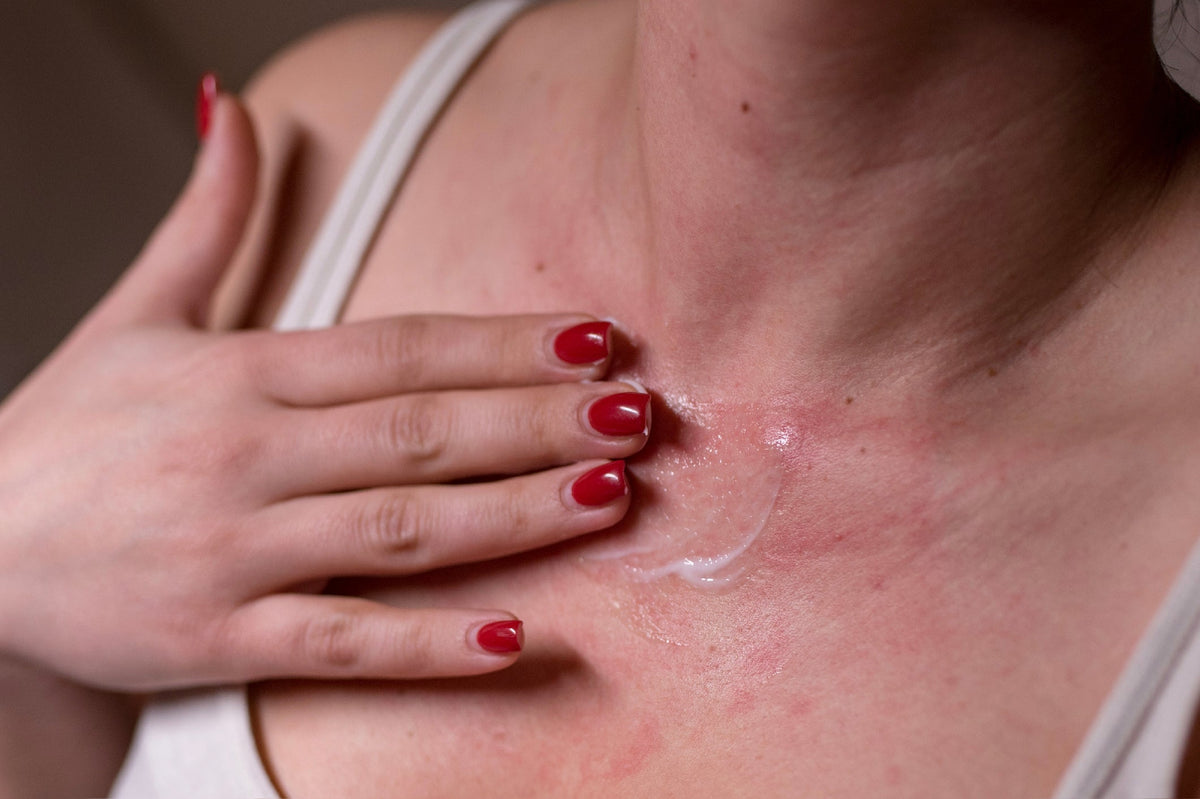 Stay Cool This Summer: Tips to Prevent and Treat Heat Rash