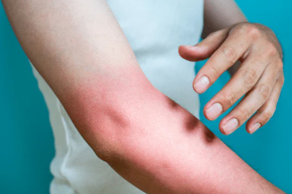 what is sun allergy