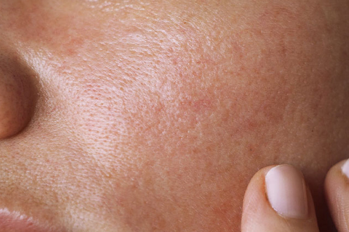 controlling oily skin