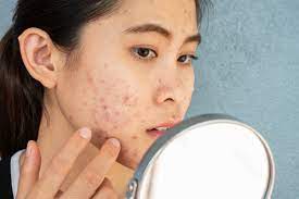 Hormonal acne: All the information you need to know is right here