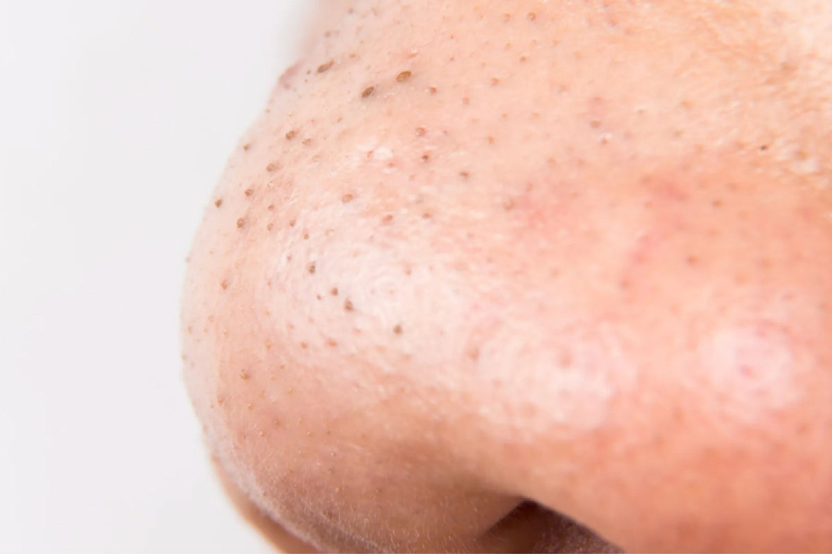 Blackheads - What Do They Look Like, Treatment And Prevention