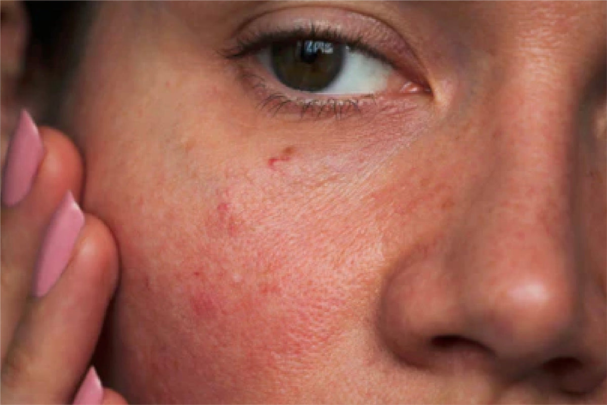 Side effects of Niacinamide