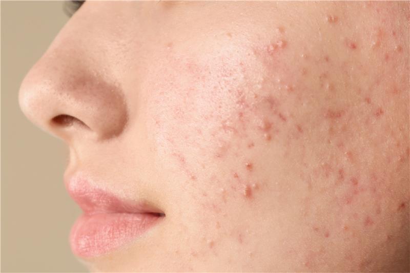 how to clear red acne marks