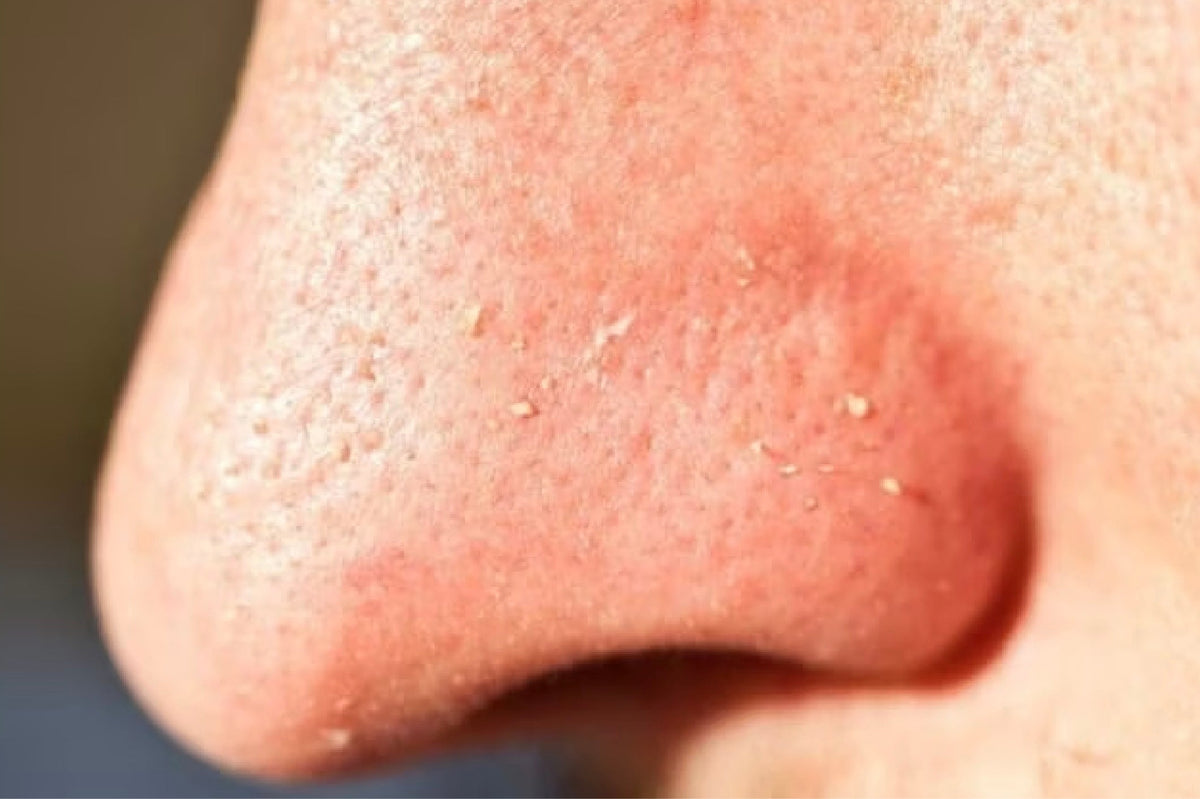 Whiteheads - Causes, Treatment, Prevention & More
