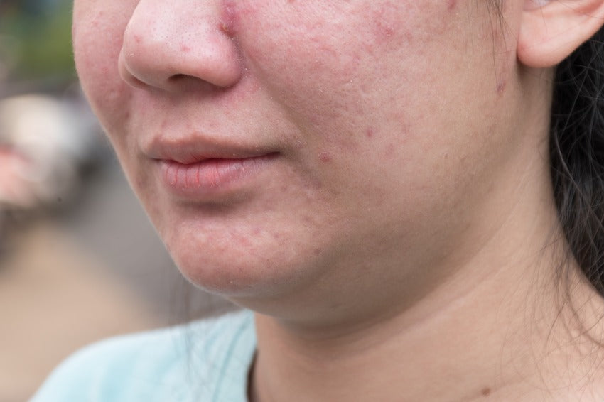 How To Repair The Skin Barrier For Dry Skin