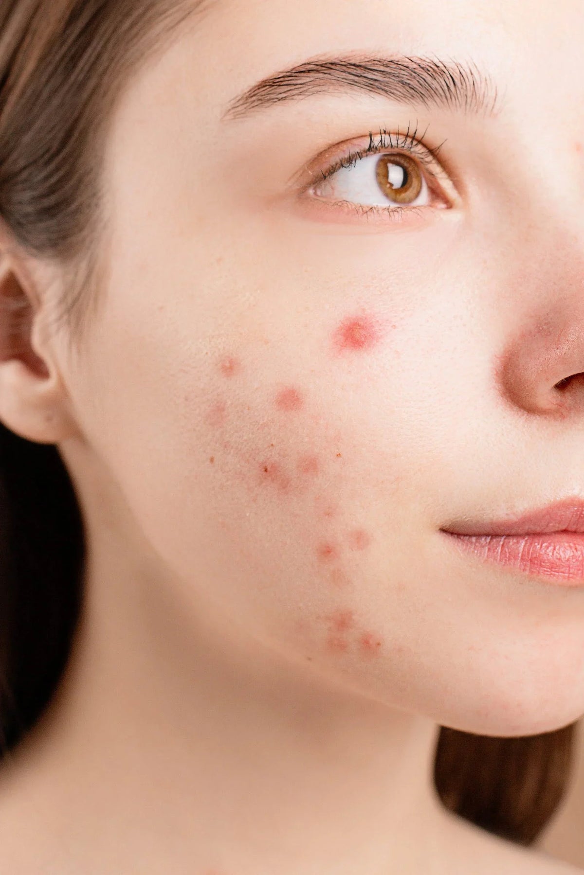 Here’s a Guide on How to Treat and Calm Acne