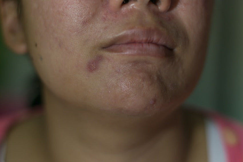 sensitive skin