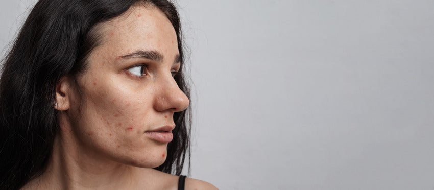 Building the Ultimate Acne Kit: Essential Products for Clear Skin