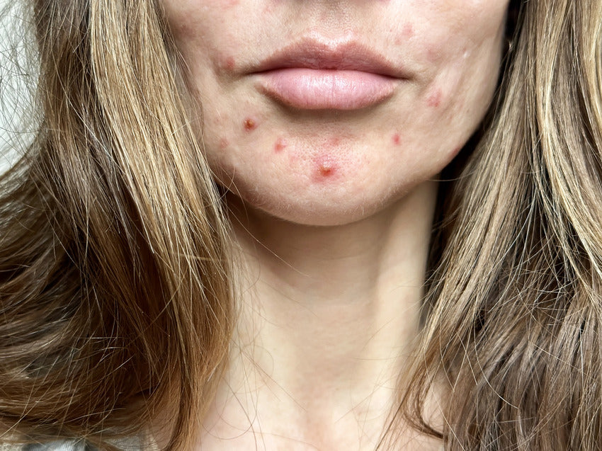 How To Treat Acne Without Drying Your Skin