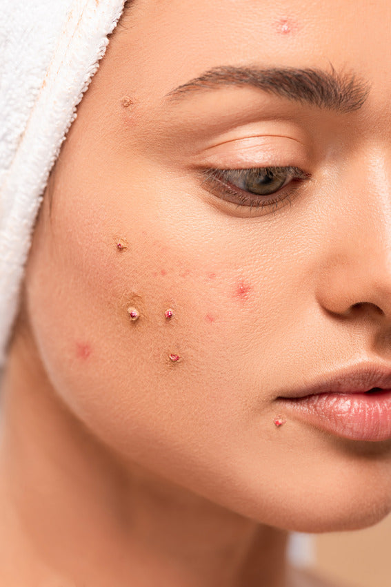 How To Improve Acne-Prone Skin