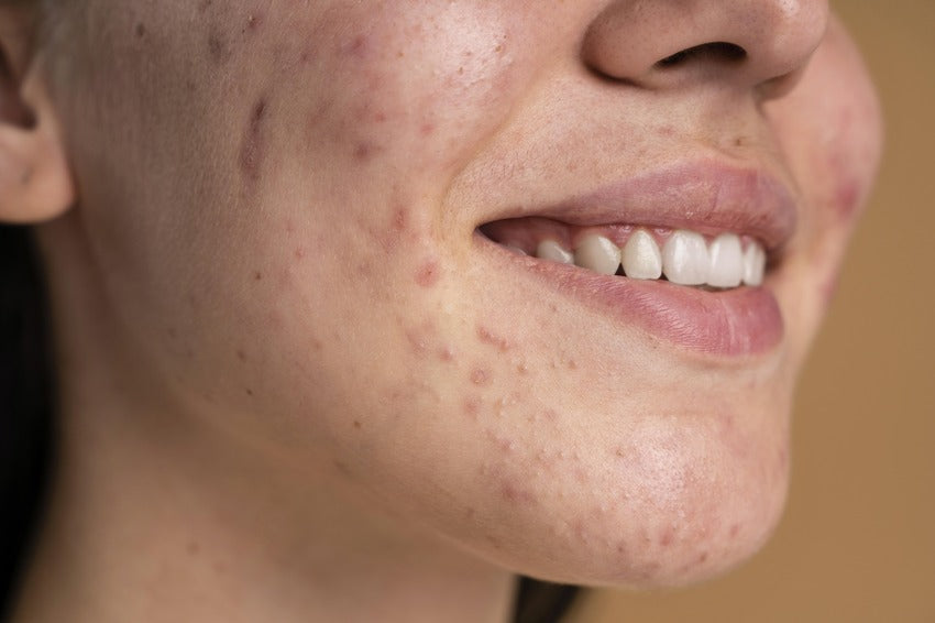 Cleanser Essentials for Acne: Ingredients to Look for and Avoid