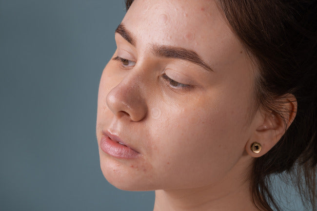 What Are Dark Spots And How To Get Rid of Them?