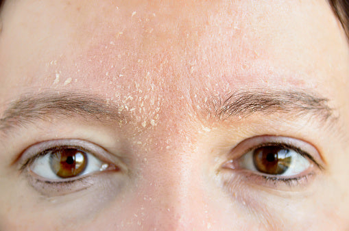 A Comprehensive Guide to Treating Dry, Flaky Skin