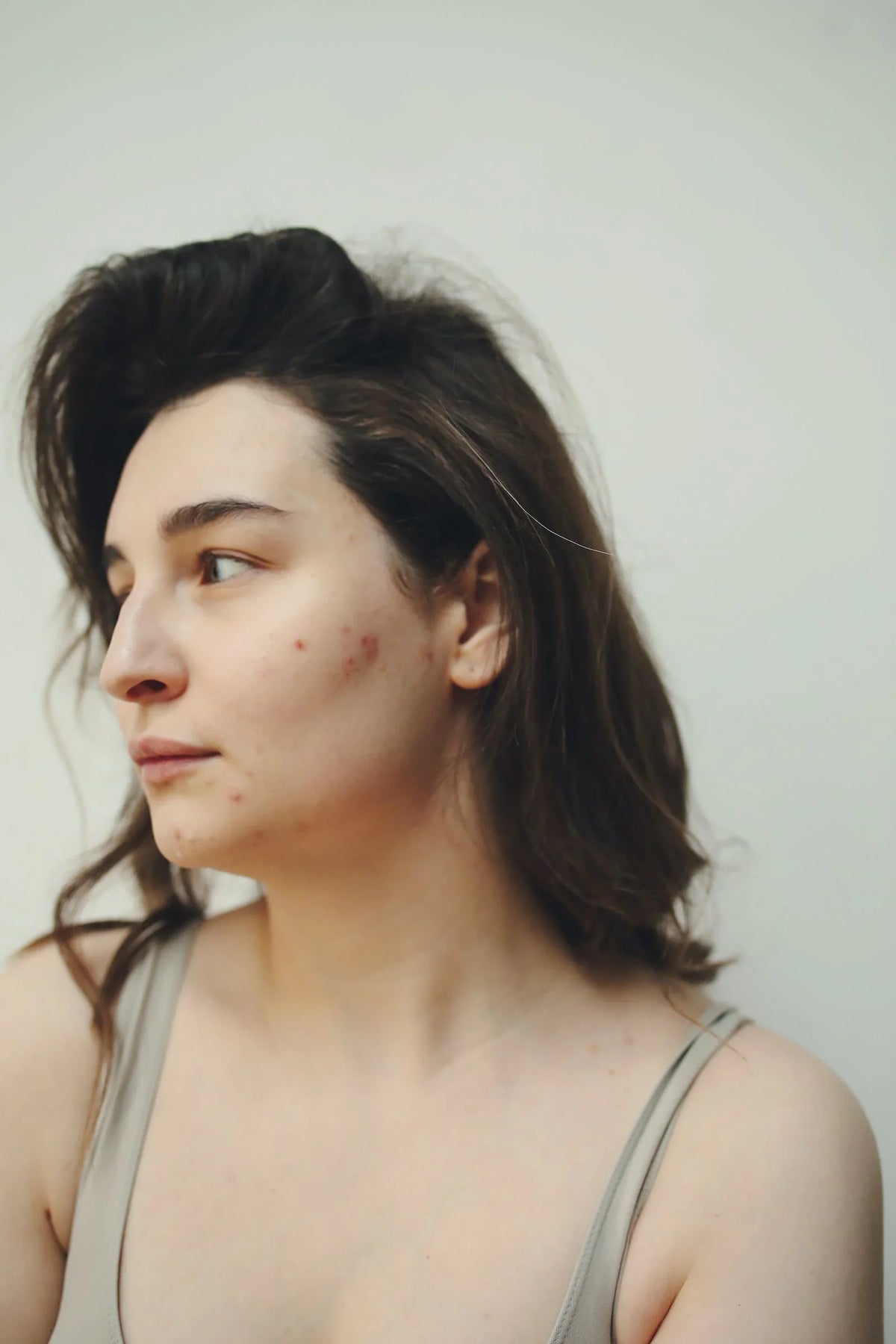 Your Ultimate Guide on How to Dry Acne Fast