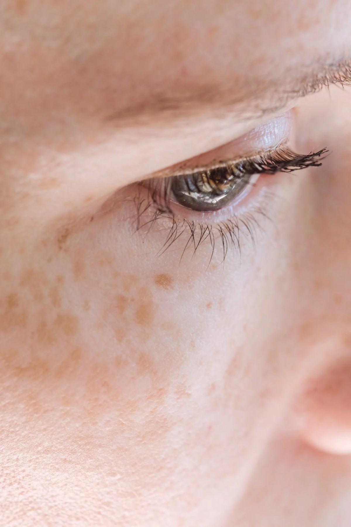 Guide to Reduce Hyperpigmentation and Dark Spots