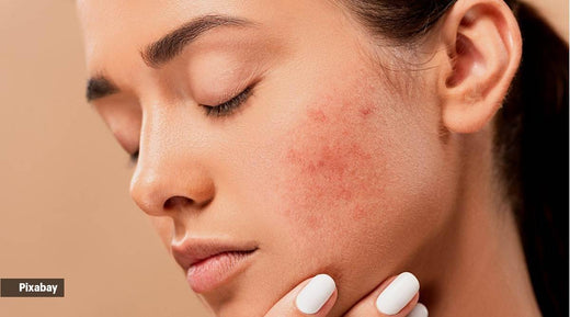 Combating acne: should you use benzoyl peroxide, salicylic acid or retinol?