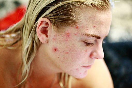 Know all about the different types of Acne out there