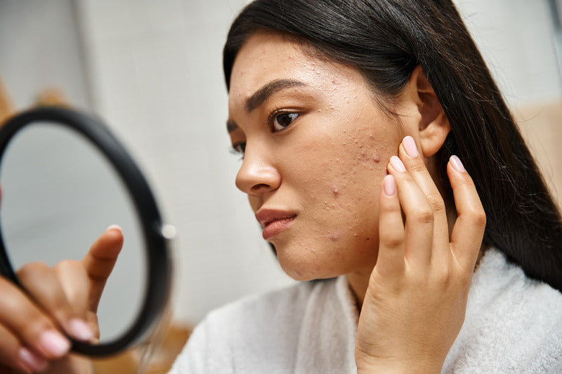 How To Care For Acne-Prone Skin?