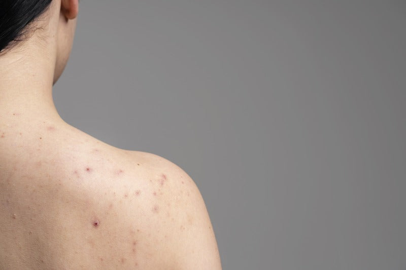 Body Acne – Causes, Types, And Treatments