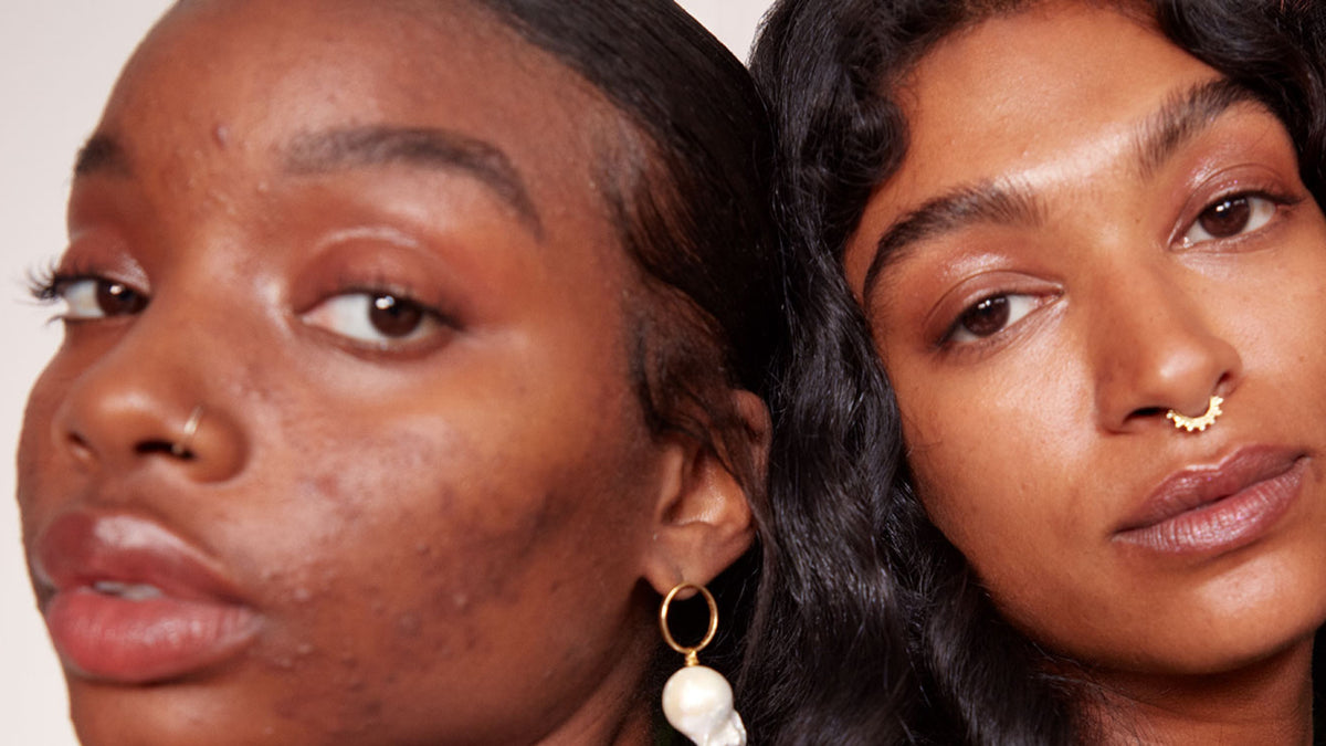Know the cause behind Hyperpigmentation & Tips to treat it effectively
