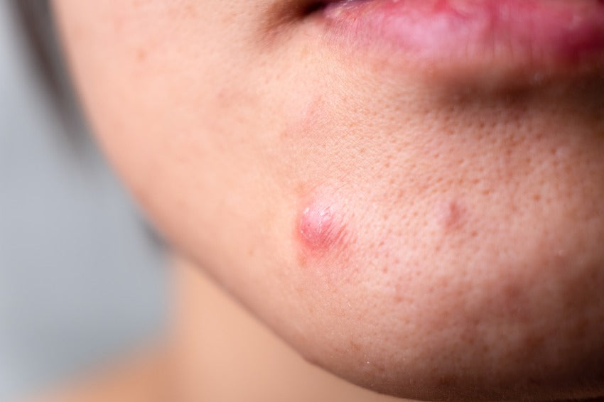 AHA, BHA, மற்றும் Niacinamide உடன் முகப்பரு பாதிப்புள்ள சருமத்தை அழிக்கவும்