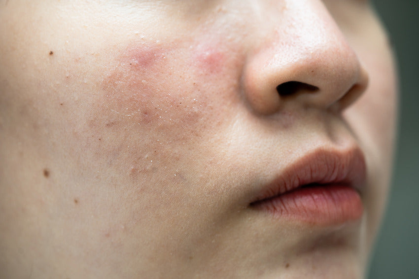What Are The Four Types Of Sensitive Skin And How To Care For It?