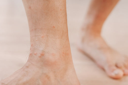 Dark Spots On The Legs: Causes And How To Treat Them
